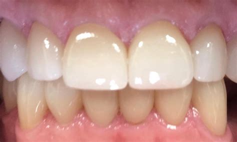 dental crowns   worn teeth mooresville nc