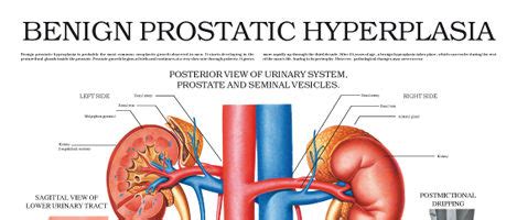 Benign prostatic hyperplasia – Anejo