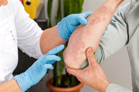 Guselkumab Shows High Efficacy in Patients With Psoriasis, History of