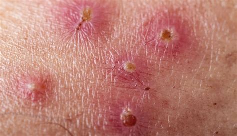 O Que Causa Impetigo - Impetigo | O que é, causas, sintomas e tratamento