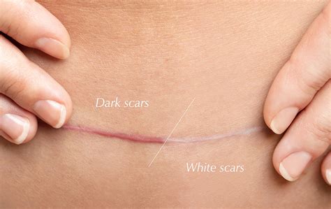 white  dark scars understanding  differences treatments