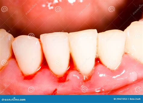 gingival bleeding stock image image  hygiene examine