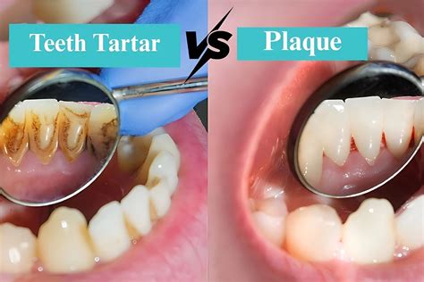 Dental Plaque And Tartar Build-Up _ How To Prevent Dental Plaque – OCAB
