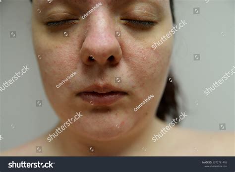 atopic dermatitis  face woman stock photo  shutterstock