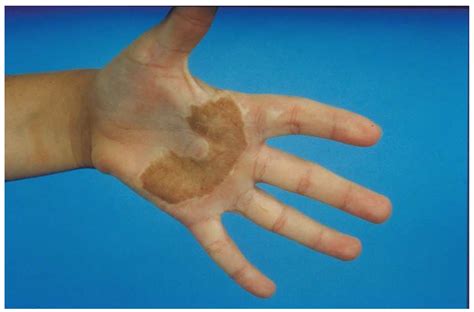 Operative Management of Burns: Traditional Care