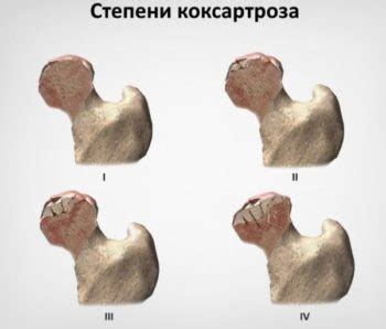 Лечится ли коксартроз тазобедренного сустава 2 степени? - Доктор Позвонков