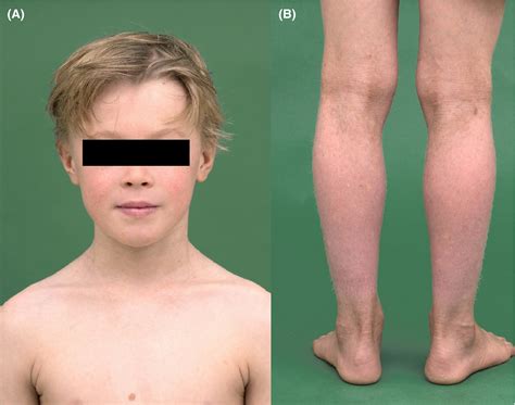 Congenital Ichthyosis