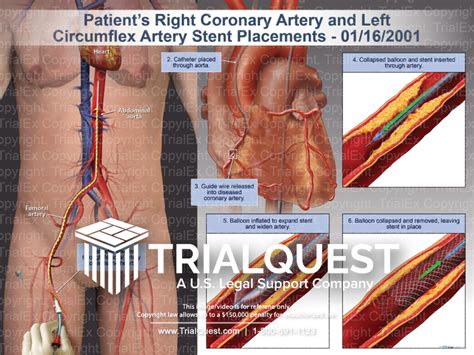 Right Coronary Artery and Left Circumflex Artery Stent Placements...