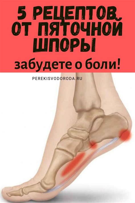 5 рецептов от пяточной шпоры: забудете о боли! | Здоровье, Журнал о ...