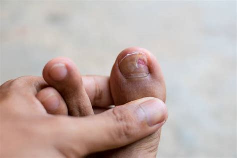290+ Curved Toenails Stock Photos, Pictures & Royalty-Free Images - iStock