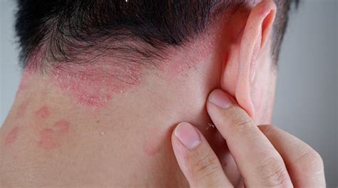 What Condition is Causing Your Itchy Scalp? - DermaZinc®