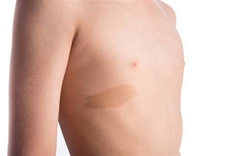 Mancha De Nascença Marrom Claro - Tratamientos para Manchas en la Piel en Bogotá | Dermosalud