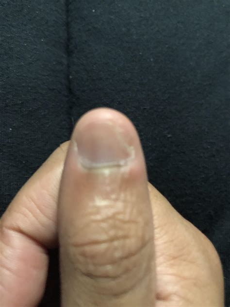 How do I fix an ingrown fingernail : r/xqcow
