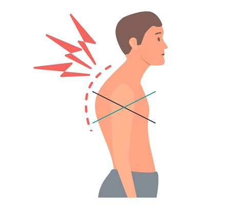 upper cross syndrome  massage    creeks massage therapy