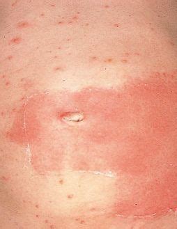 赤ちゃんの皮膚の病気 接触皮膚炎の症状とケア【医師監修】｜たまひよ