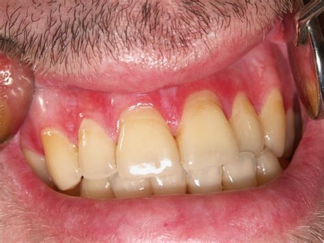 Doença Do Enxerto Contra O Hospedeiro - Doença do Enxerto contra o Hospedeiro (DEcH) Oral – OPMDCARE
