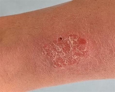 Psoriasis – An Itch You Don’t Want to Scratch! – Codex Labs Corp