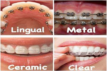 orthodontic correction  teeth dr jinus dental care  kochi