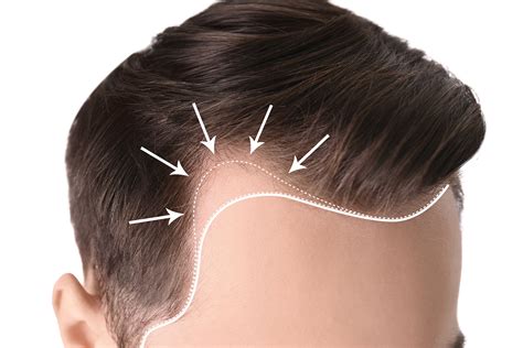 attaccatura dei capelli cosa bisogna sapere hasson wong