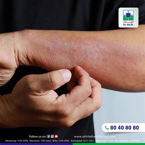 dermatitis symptoms diagnosis treatment  prevention