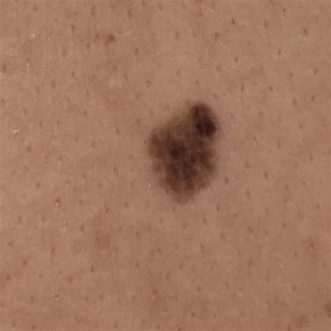 precancerous moles neoplasms guide  skin anomalies