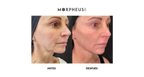 Morpheus Rosto Antes E Depois - morpheus8 - Dra. Bugallo Medicina Estética