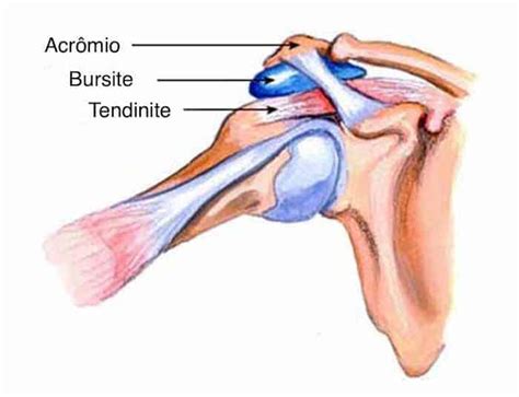 O Que Causa Bursite - Bursite: O que é? Causas, sintomas e tratamentos - Clínica Dr. Hong Jin ...