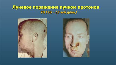 Острая лучевая болезнь. Mестное лучевое поражение - презентация онлайн