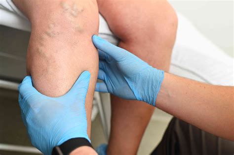 Deep Vein Thrombosis (DVT): Symptoms, Treatment, & More