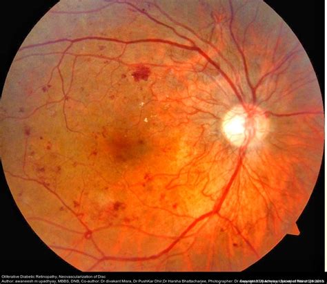 Diabetic Retinopathy | Annan Retina Eye Center in Houston, Texas