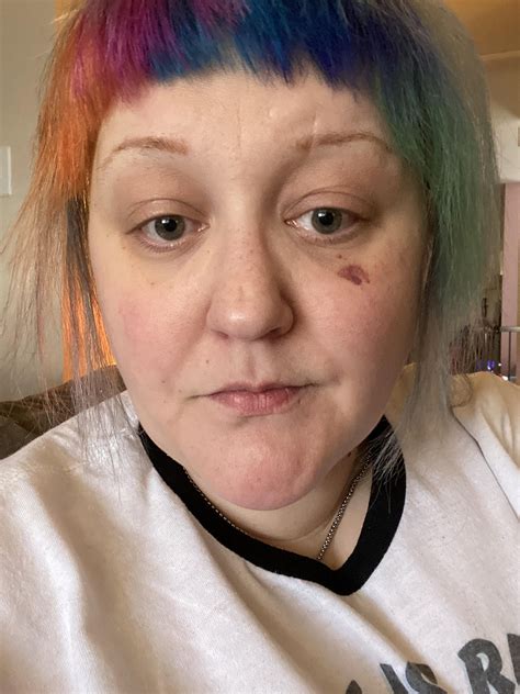 Bruised face during holidays 😅 : r/makeuptips