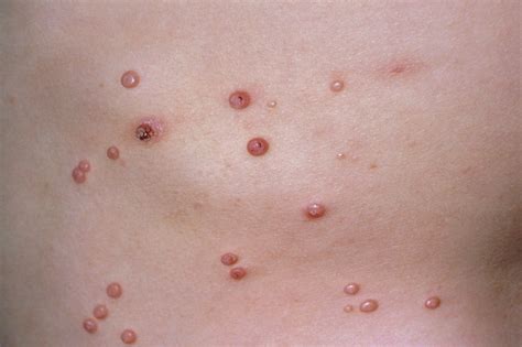 Molluscum Contagiosum Infection