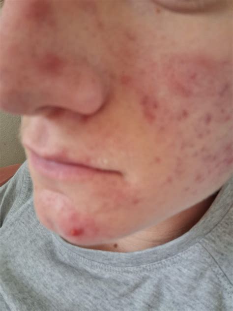 Sind Pikel hormonel oder vererbt? Bzw was hilft am schnellsten gegen