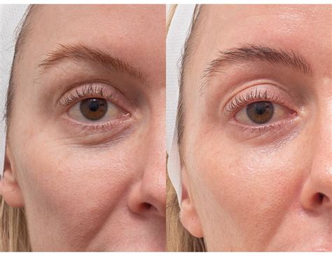 laser resurfacing melbourne northside dermatology