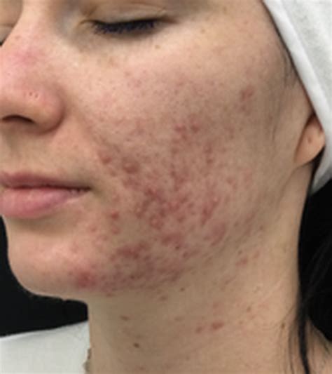 BBL Treatments | Laser Clinics Australia