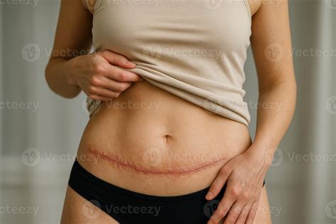A healing scar after abdominal surgery is visible on a woman's body