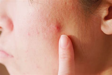 teenagers  acne       skin issue