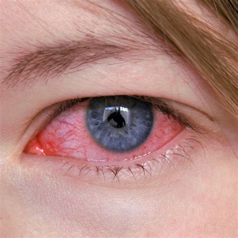 eye injuries treatment boise id clear eye total eye care