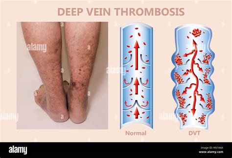 Economy class syndrome mechanism, deep vein thrombosis or DVT ...