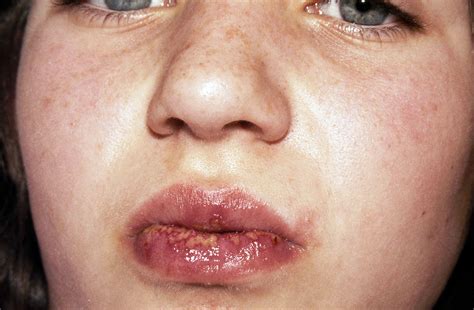 Causes Of Lip Swelling In Children - Infoupdate.org