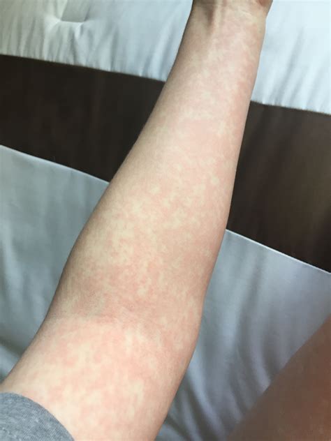 Is Your Rash From Lamictal? Visual Guide And When To See A Doctor 17