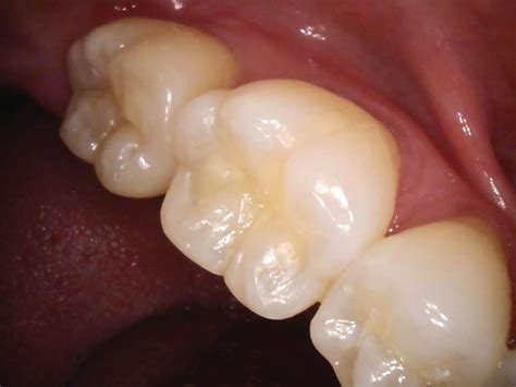 How to achieve long-lasting, natural-looking restorations