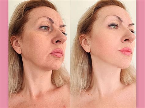 Bioestimulador De Colágeno No Rosto Antes E Depois - Sculptra - O que é, resultado e valor do bioestimulador de colágeno
