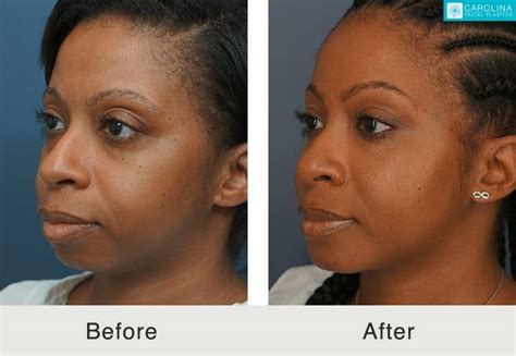 Before & After Chin Implant - Carolina Facial Plastics