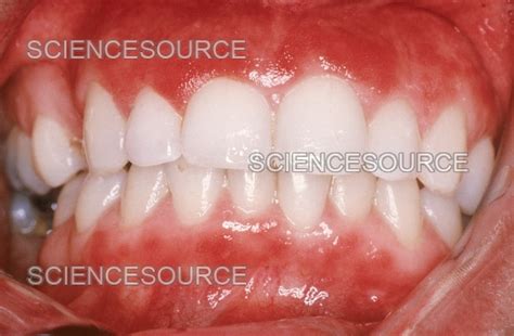 Photograph | Gingivitis | Science Source Images