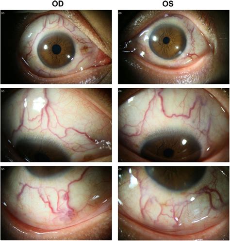 escotoma centelleante