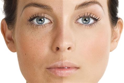 treating uneven skin tone aesthetic dermatology center