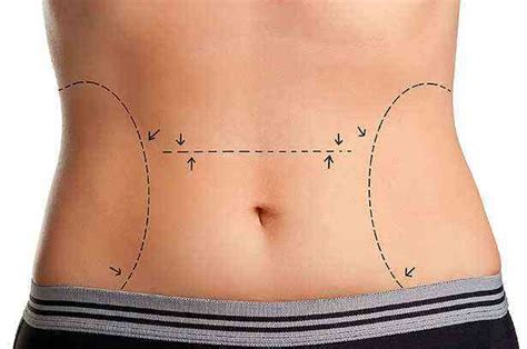 Conheça tipos de lipo disponíveis e vantagens e desvantagens de cada ...