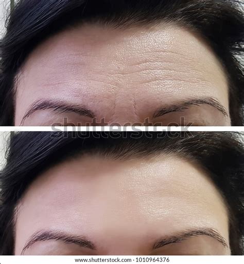 forehead women wrinkles   stock photo edit