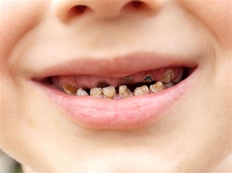 UK's 'sugar addiction' leading to 170 NHS operations a day to remove ...